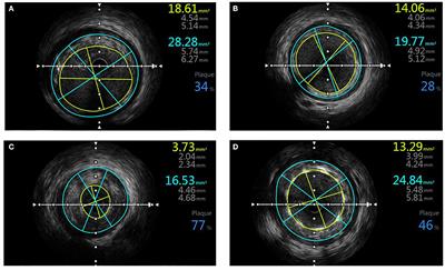 Microvascular and Prognostic Effect in Lesions With Different Stent Expansion During Primary PCI for STEMI: Insights From Coronary Physiology and Intravascular Ultrasound